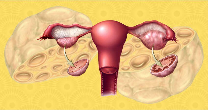 pcos symptoms and treatment