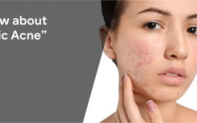 what is cystic acne
